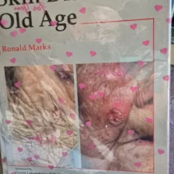 Skin Disease in Old Age - Ronald Marks
