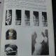 RADIOLOGIE MEDICALA BUCURESTI 1980-IOAN BIRZU