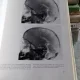 PNEUM-ENZEPHALO GRAPHISCHE ANATOMIE DES KINDERGEHIRNS - DAGOBERT MULLER (ANATOMIE GRAFICA ENCEFALOTRIGEMINALA A CREIERULUI COPILILUI)